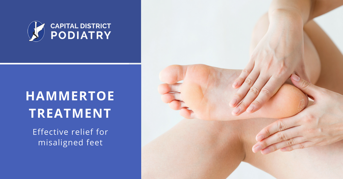 Hammertoe Treatment